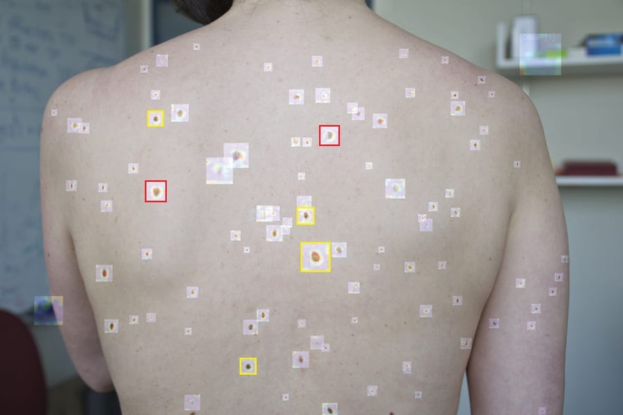 New artificial intelligence tool can help detect melanoma
