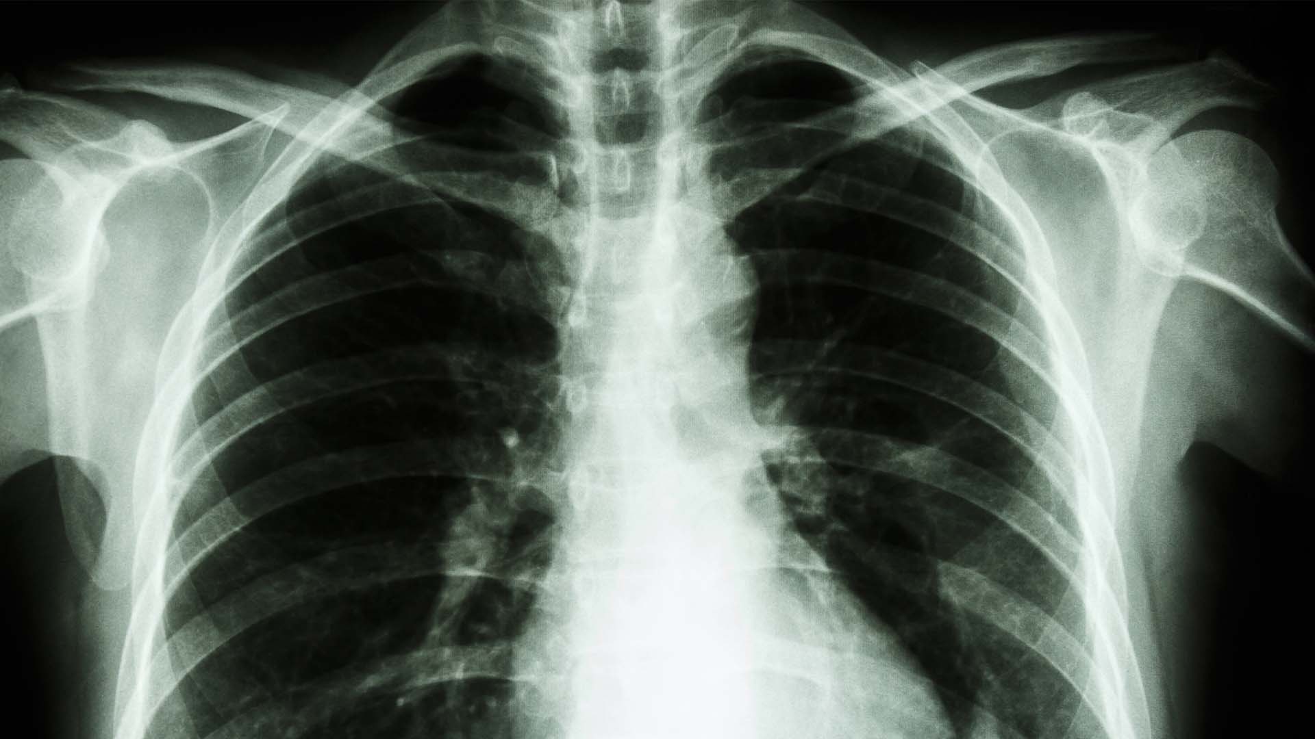 AI predicts heart disease using a single X-ray - AIMed